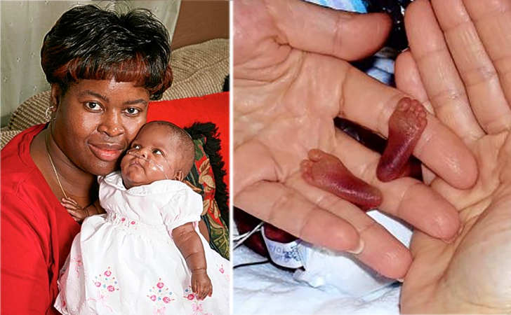 10 Amazing Newborns Who Survived The Impossible (PHOTO)