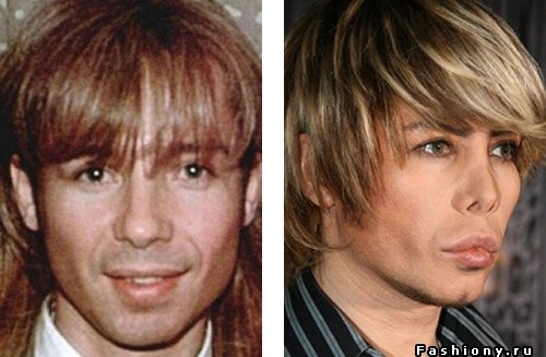 Russian stars before and after plastic (PHOTO)