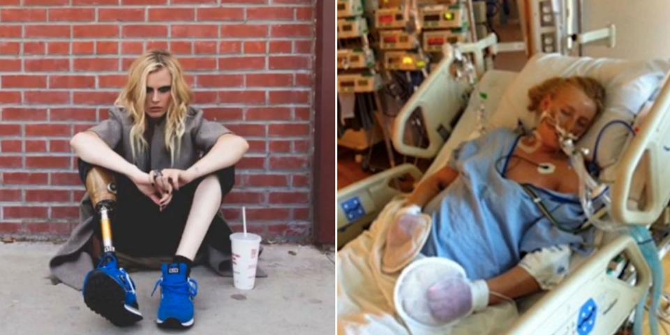 24-Year-Old Model Who Lost Her Leg From Using Tampons: «I Was 10 Minutes From Death»