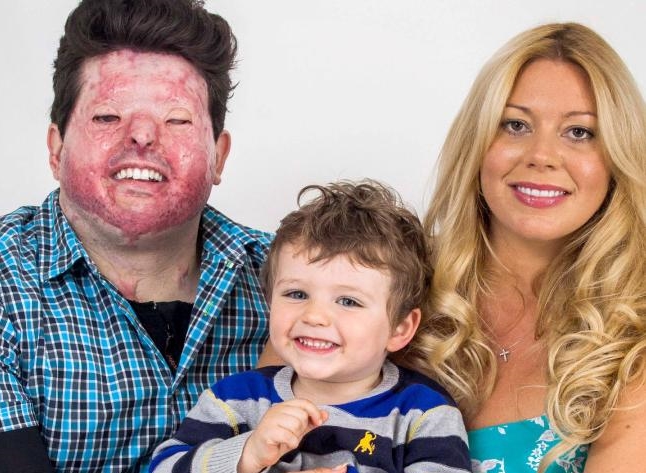 ‘I was scared my son would think I’m a monster’: Victim of mistaken identity acid attack speaks out