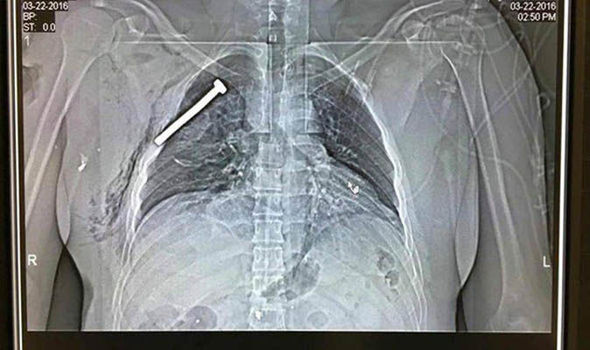 INCHES FROM DEATH: X-ray shows BOLT from ISIS nail bomb lodged in Brussels victim’s chest