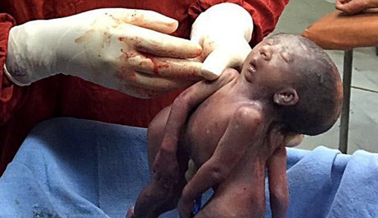 The Siamese twins who shared a FACE: Heartbreaking pictures show babies born with just one head between them