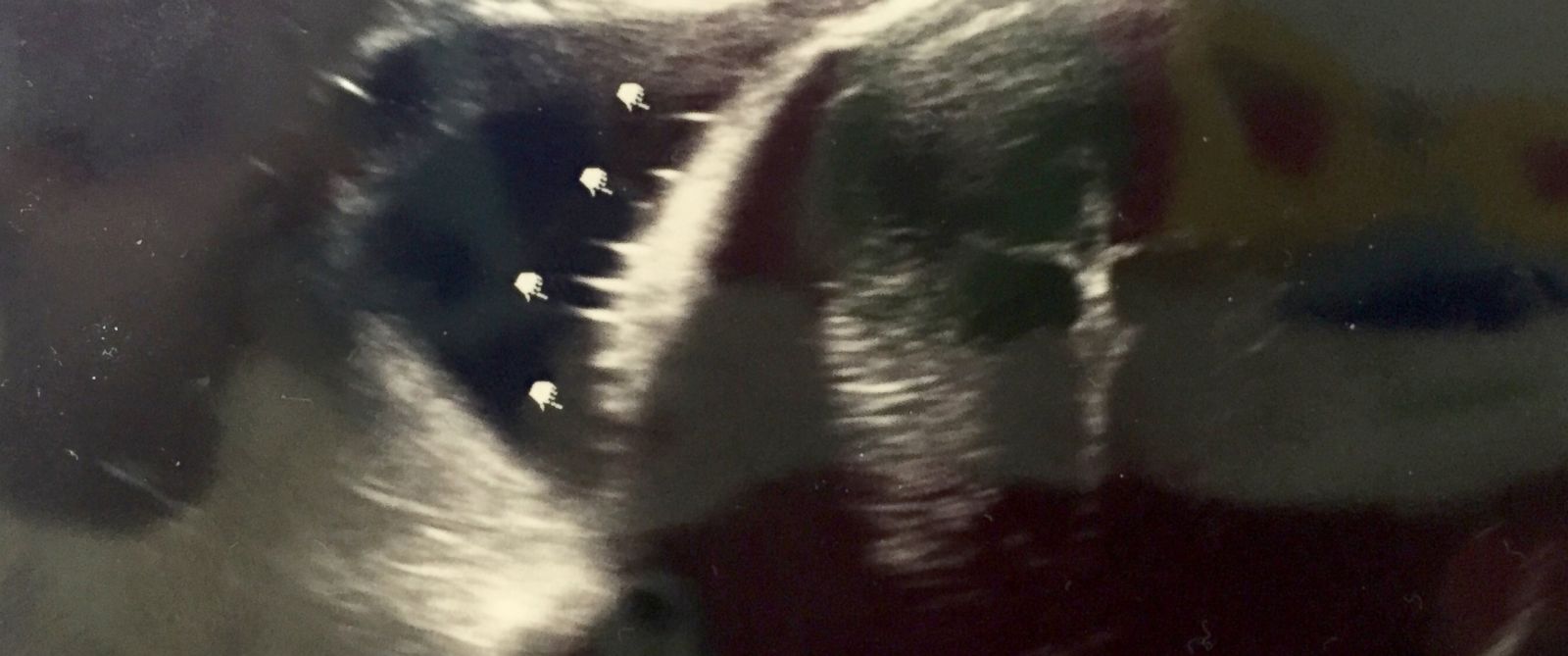 Mom Shocked After Noticing What Appears to Be a Crucifix in Sonogram