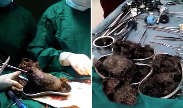 GRAPHIC CONTENT: Giant HAIRBALL removed from teenager girl’s stomach