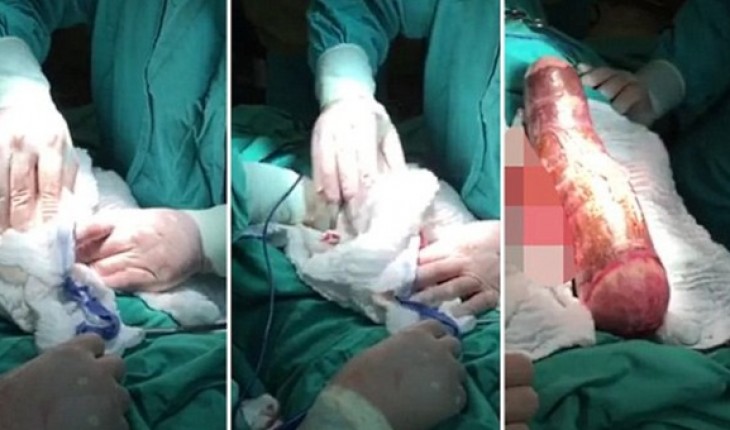 Doctors remove 18-inch cassava from man who tried to use it as a pleasure toy