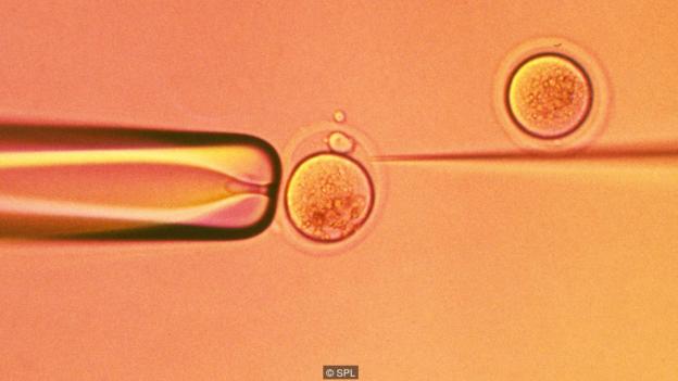 In vitro fertilisation. Light micrograph of a micro-needle (right) that is being used to inject a human sperm cell into a human egg cell. The tip of a micro-pipette (left) is holding the egg cell in place. This in vitro fertilisation (IVF) technique is known as intracytoplasmic sperm injection (ICSI). The injected sperm fertilises the egg and the resulting zygote is then grown in the laboratory until it reaches an early stage of embryonic development. It is then implanted in the patient's uterus, where it develops into a foetus. IVF allows infertile couples to conceive a child.