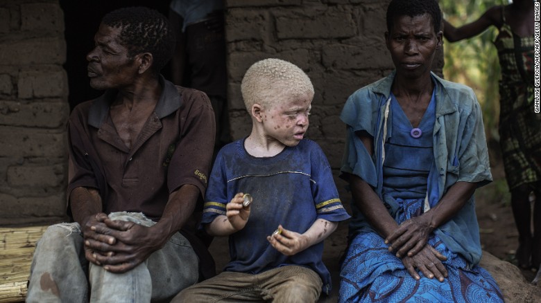 Hunting for humans: Malawian albinos murdered for their bones