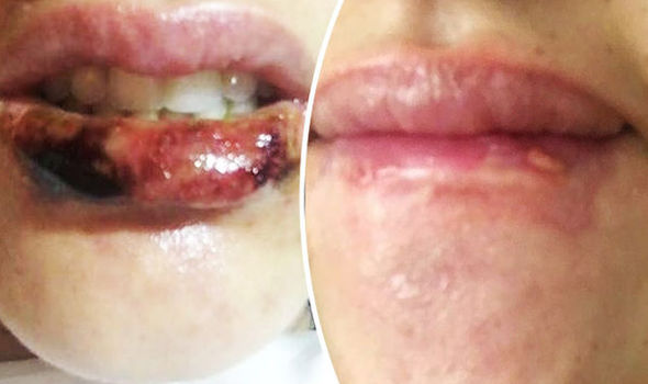 ‘I nearly lost my lips’ Warning to women as Kardashian look treatments go horribly wrong