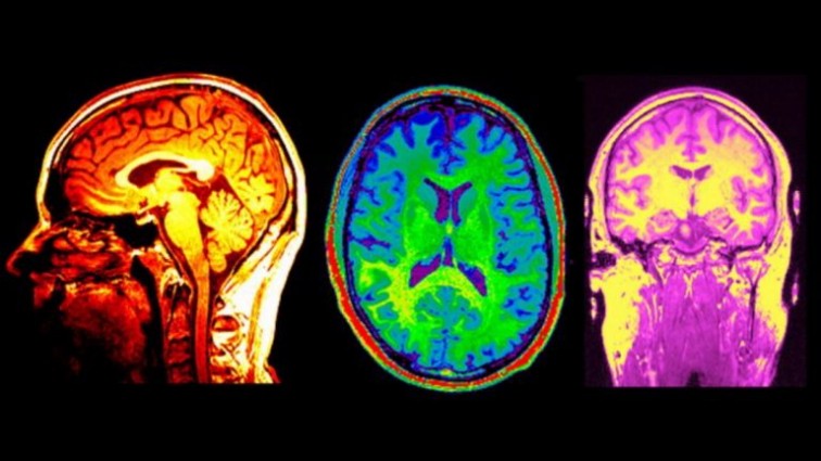 Учёные обнаружили связь между повреждениями в мозге и властью
